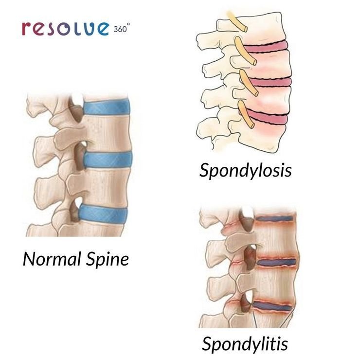 Cervical & Spondylitis Therapy