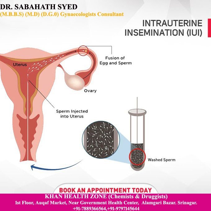 IUI (Intrauterine Insemination) Treatment Service –