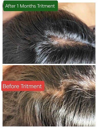 Hair Fall & Regrowth Treatment