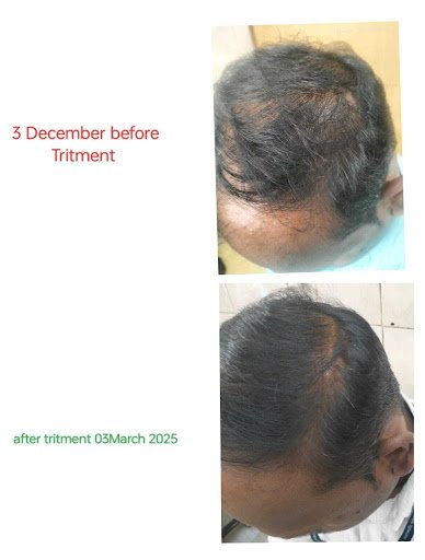 Hair Regrowth Treatment Service