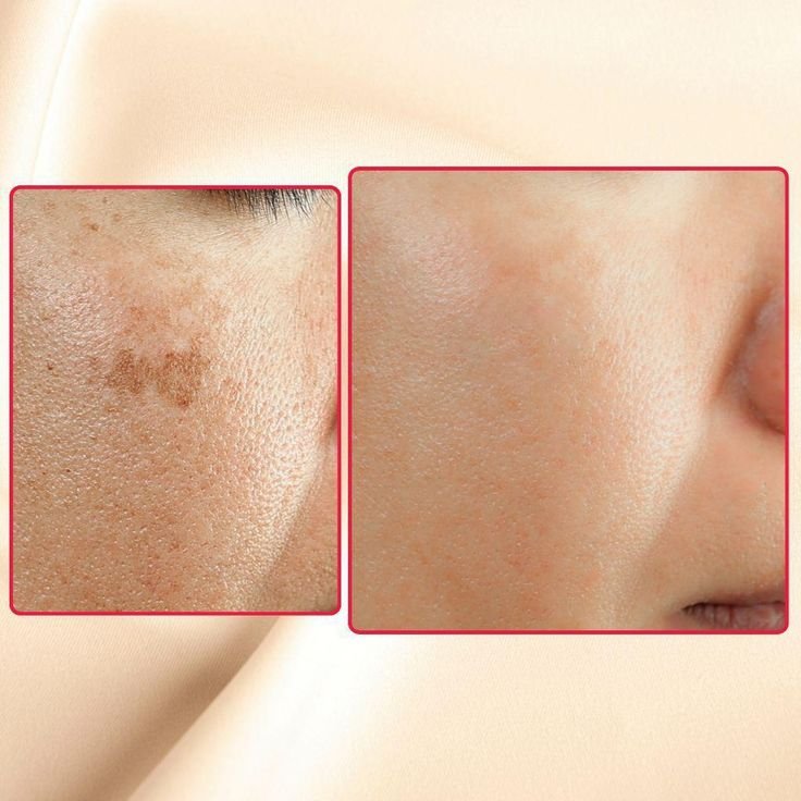 Dark Spot Reduction