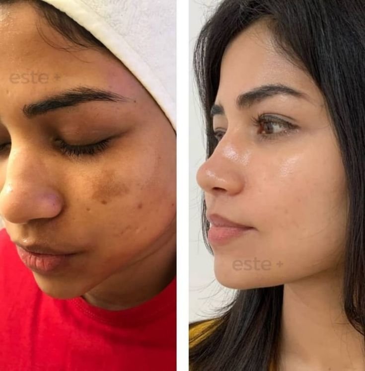 Pigmentation Correction –