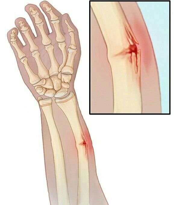 Fracture Treatment