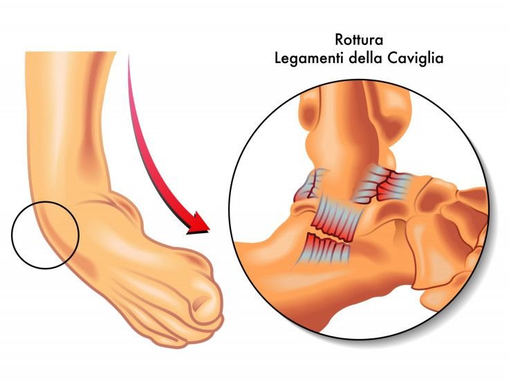 Sprain & Ligament Care