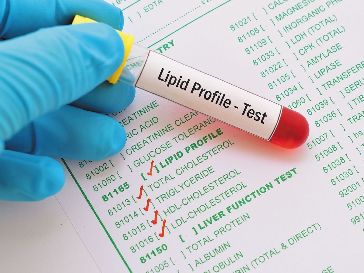Lipid Profile Test